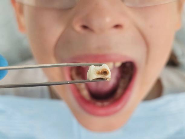 Best Emergency Dentist for Knocked-Out Tooth in Ridgely, TN